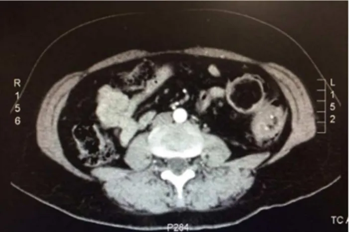 Fig. 1 – Abdominal CT with left colon thickening.