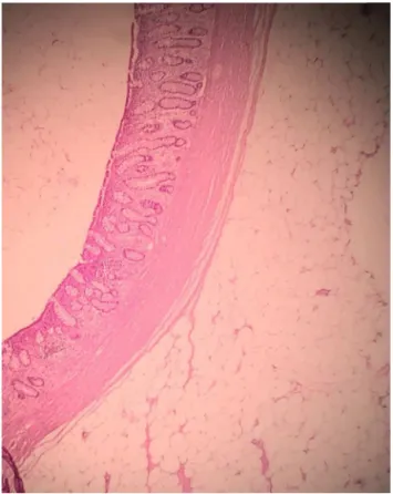 Fig. 4 – Histology of lesion compatible with submucosal lipoma.