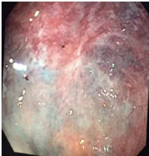Fig. 2 – Intermediate portion of the rectum with vascular lesion.