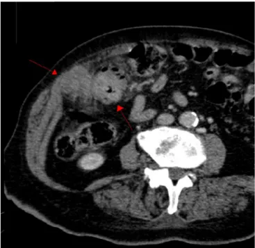 Fig. 1 – Computed tomography of the abdomen showed a liver angle lesion with local peritoneal infiltration and lymph node enlargement in the root of the middle colic artery.