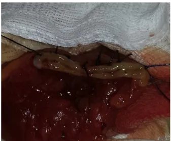 Fig. 3 – Positioning the colon end.