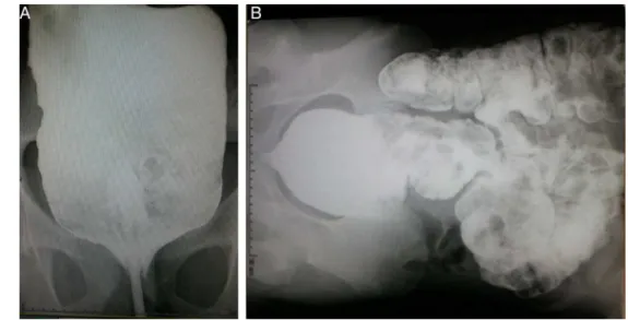 Fig. 1 – Barium enema.