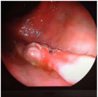 Fig. 1 – Colonoscopic appearance of the inflammatory cloacogenic polyp.