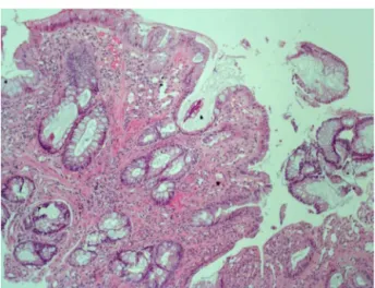 Fig. 2 – Elongated, irregular crypt structures, hyperplastic changes in the lamina propria fibromuscular hyperplasia and chronic inflammation (hematoxylin eosine × 100).
