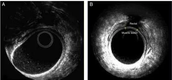 Fig. 1 – Injuries analyzed by 3D-AUS (axial cuts). (A) Lesion involving perirectal tissue and (B) a lesion involving the rectal muscle layer.
