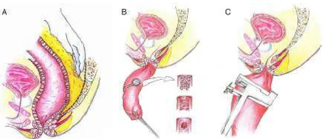 Fig. 2 – Sequential overview of the Pull-through procedure in schematic representations