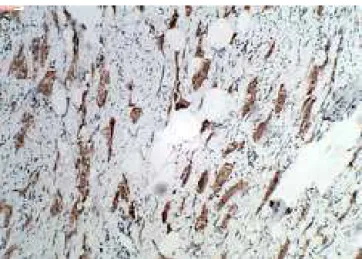 Fig. 4 – Groups of positive tumor cells in immunohistochemistry for CD-68 (100×).