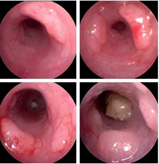 Fig. 2 – Endoscopic visualization of AOM-induced tumors in mice. Adapted from Neufert et al