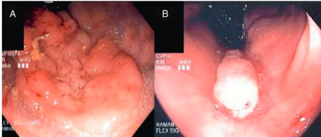 Fig. 1 – Pre-operative flexible sigmoidoscopy showing left posterolateral 4 cm × 3 cm polyp (A) and follow-up flexible sigmoidoscopy five months post-operatively demonstrating healed posterior rectal mucosa (B).