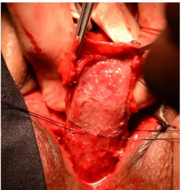 Fig. 1 – The vertical incision performed to proximal anal sphincteric segment for showing the lower rectum.