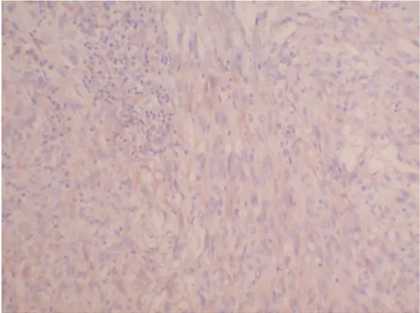 Figura 3. Imunohistoquímica CD31 Sarcoma Kaposi