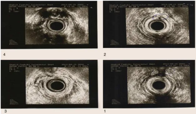 Fig. 2 – Injury to anterior portion of external sphincter of the second patient (blue circle shows site of injury).