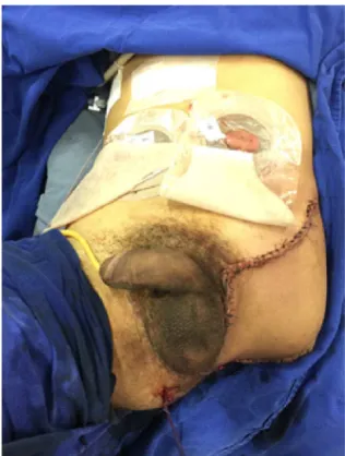 Fig. 3 – Final aspect after reconstruction with lateral thigh flap.