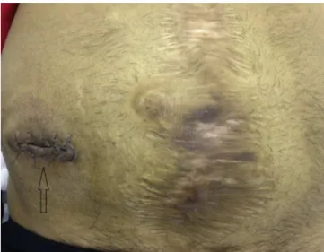 Fig. 3 – Final appearance of the abdomen. Arrow, ITR incision.