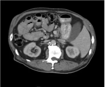 Fig. 2 – Abdominal computed tomography showed a colonic mass located in ascending colon, which was inverted on the left side.