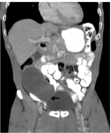 Fig. 3 – Lesion in topography of cecal appendix, hypodense, in a sagittal CT of abdomen (arrow).