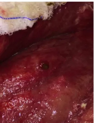 Fig. 2 – Vermiform appendix fistulizing in the granulation area.