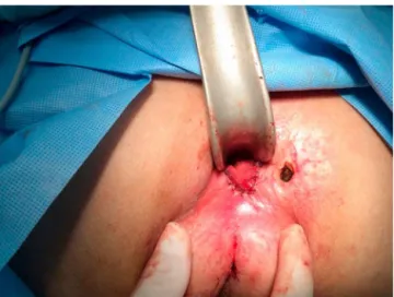 Fig. 4 – Final aspect of procedure.