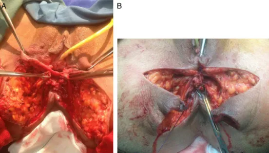 Fig. 3 – (A) Separation of ano-rectum from the vagina by dissecting the recto-vaginal septum; (B) performance of sphincteroplasty in order to overlapping the internal and external sphincter.