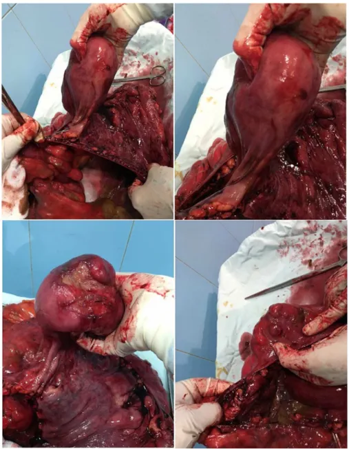 Fig. 3 – The removed sections of sigmoid and upper rectum.