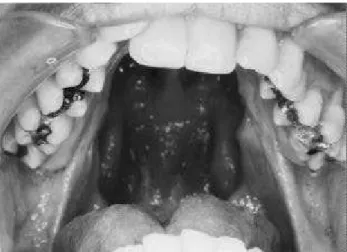 FIGURE 1A - Patient with open palate