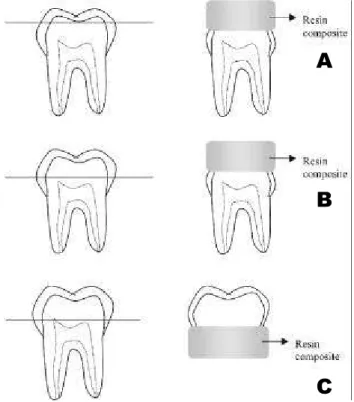 FIGURE 1- (A) superficial dentin preparation; (B) deep dentin preparation achieved via occlusal access, and (C) deep dentin preparation achieved via apical access.