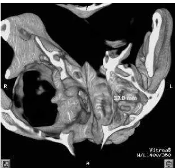 FIGURE 1- 2D-CT axial view is demonstrating the largest diameter delimitation of maxillary sinuses (arrows)