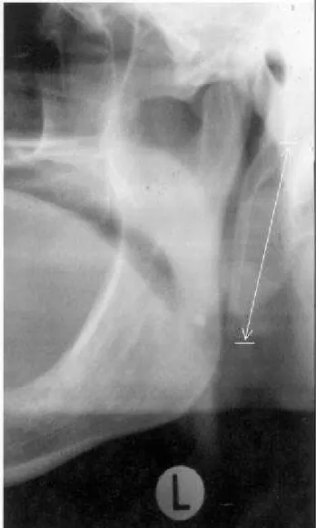 FIGURE 1-  Part of panoramic radiograph showing an elongated styloid process, on left side