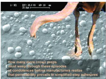 FIGURE 13 - Transudation of dentinal fluid continued after the removal of the provisional crown seven days after sealing with another single-bottle adhesive