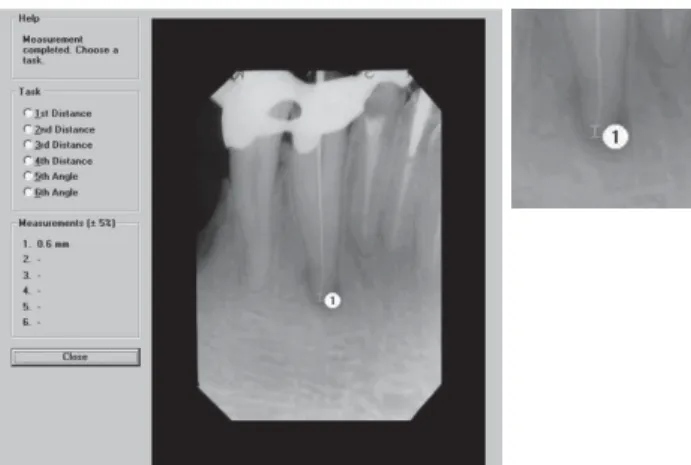 FIGURE 1- Digora Mesuring Tool. (A) Delimiting reference points