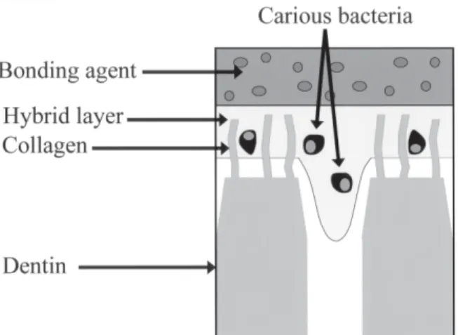 TABLE 1 - Tensile bond strength of ABF (Protect Bond) in normal, caries-affected and caries-infected dentinFIGURE 1 - The concept of Modified Sealed Restoration (MSR).