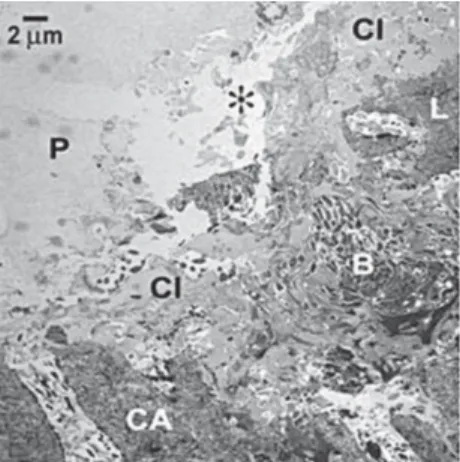 FIGURE 5 - Bonding of the ABF system to caries-infected dentin showing the variability of the pathological bonding substrate