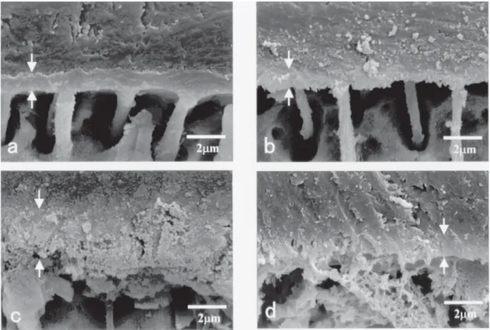 FIGURE 8  -SEM micrographs of the resin-dentin interfaces in coronal dentin (a),root dentin(b),caries-affected dentin(c) and caries-infected dentin(d)