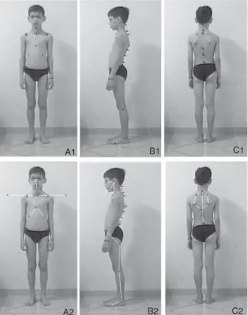 FIGURE 1- Delineated anatomical points analyzed. A1, A2 – Anterior: (1,2) right and left glabella, mentum and coracoid process (RGMCP and LGMCP, respectively); (3,4) coracoid process, condylar angle and right and left horizontal (RCPCH and LCPCH, respectiv