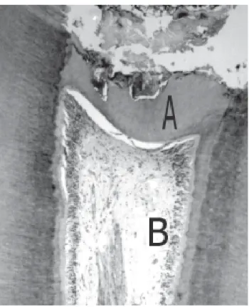 FIGURE 3- White Portland cement (120 days). H.E. 40 X. (A) Dentin bridge