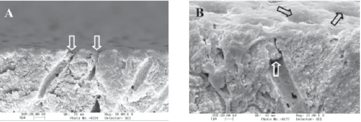 FIGURE 4-  SEM micrograph of acidulated phosphate fluoride-treated dentin. Note the precipitates within the tubules and below the surface (white arrow), and the funnel shape dentinal tubules opening (black arrows)