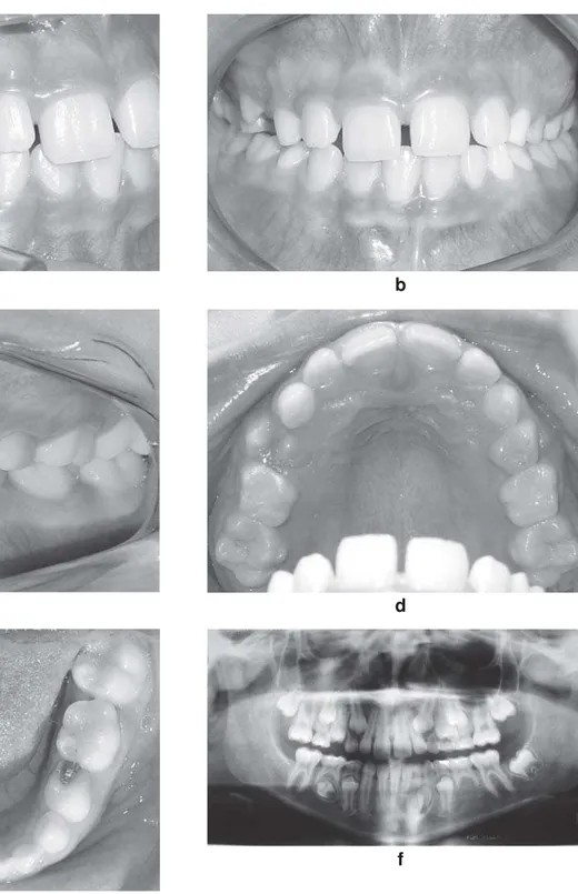 FIGURE 1-  (a-f) Initial intraoral photographs and panoramic radiograph