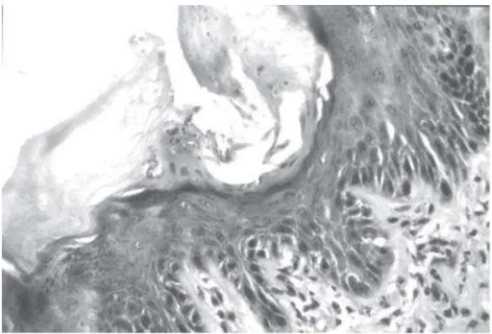 FIGURE 4- Microscopic section of a specimen in Group IV presenting extensive area of hyperkeratinization, loss of normal epithelial stratification, loss of polarity and disorganization of the basal layer, nuclear pleomorphism and increased number of mitose