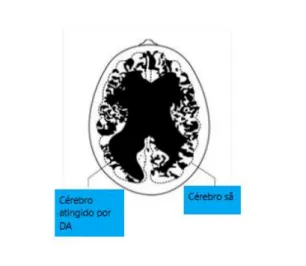 Figura 1- Esquema representando um corte transversal de um cérebro atingido por DA e um cérebro sã,  adaptado do esquema de Martone e al, 2019