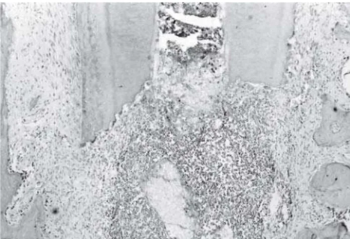 FIGURE 4 - Higher magnification of Figure 3. Neutrophils and chronic inflammatory cells are surrounding a particle of the filling material (FM)