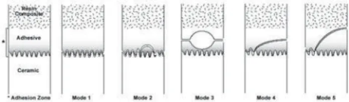 FIGURE 6-  Schematic representation (side view) of the modes of failure for the microtensile bond strength test of ceramic bonded to resin composite, based on crack initiation and principles of fractography