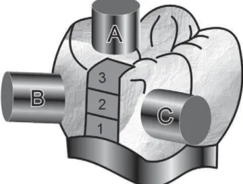 FIGURE 1- Schematic drawing of the material insertion and light curing