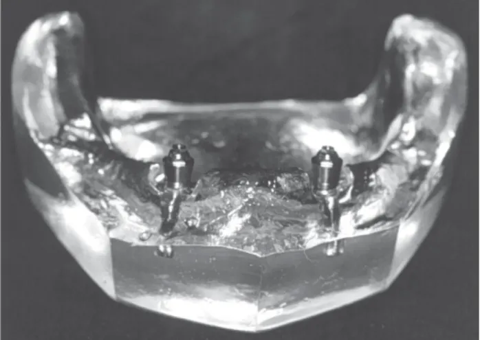 FIGURE 1-   Acrylic resin model with two external hex cylinder implants. Abutments were connected to the implants