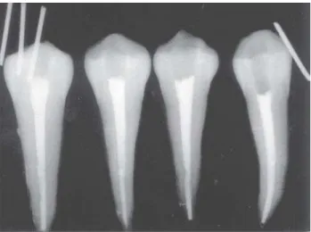 FIGURE 2-  Radiograph image of teeth after the filling of the buccal lateral canals