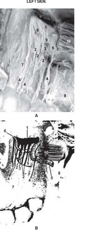 FIGURE 1-  DISSECTIONS (A) AND SCHEMATIC DRAWINGS (B) OF THE ZYGOMATIC REGION, SHOWING TUBERAL DISTRIBUTION OF THE MAXILLARY NERVE AND ARTERY AND THEIR BRANCHES: