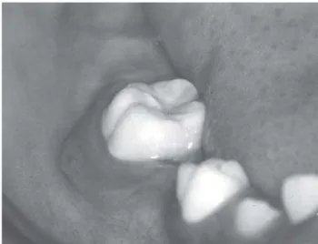 Figure 10- X ray showing small cavity but caries spreading at dentin-enamel junction