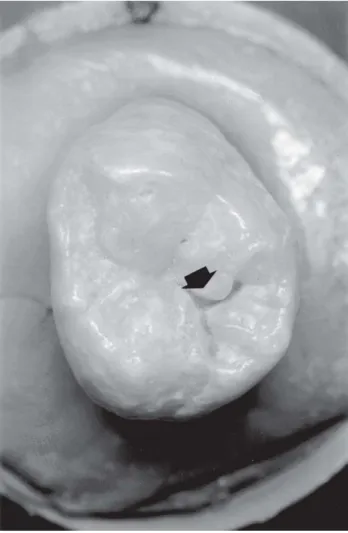 FIGURE 1- Macroscopic aspect of site (arrow) of the occlusal surface of a third molar evaluated by visual inspection, visual inspection and blunt-tipped probes (Tactile), endoscopic evaluation (AccuCam), conventional bite-wing (RxC), direct bite-wing digit