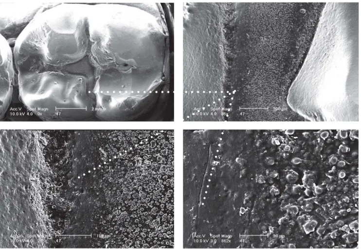 FIGURE 6- Various SEM magnification aspects of the altered glass-ionomer sealing of Figure 5○○○○○○○○○○○○○○○○○○○○○○○○○○○○○○○○○○○○○○○○○○○○○○○○○○○○○○○○○○○○○○○○○○○○○○○○○○○○ REFERENCES