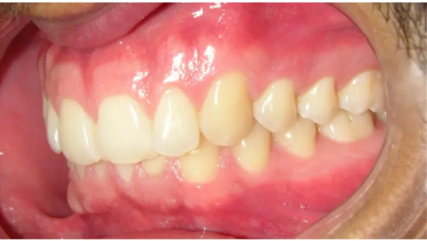 Figura 2- Vista oclusal esquerda: boa oclusão dentária e saúde periodontal.