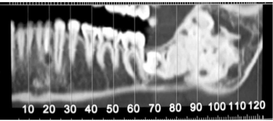 Figura 5- Área hipodensa associada a formações hiperdensas homogêneas, de limites bem definidos, estendendo- estendendo-se da região de molares ao ramo mandibular, à esquerda, estendendo-sem atingir os processos coronóide e condilar.